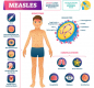 Measles Infographic